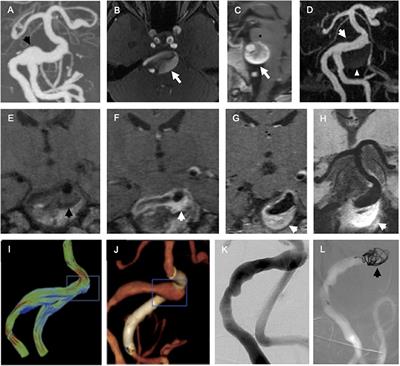 Endovascular Biopsy of Vertebrobasilar Aneurysm in Patient With Polyarteritis Nodosa